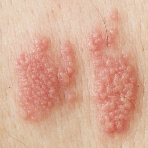 genital herpes symptoms on skin
